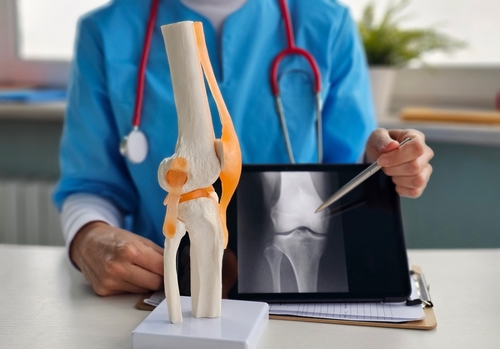 Reemplazo de rodilla &ndash; cirug&iacute;a especializada